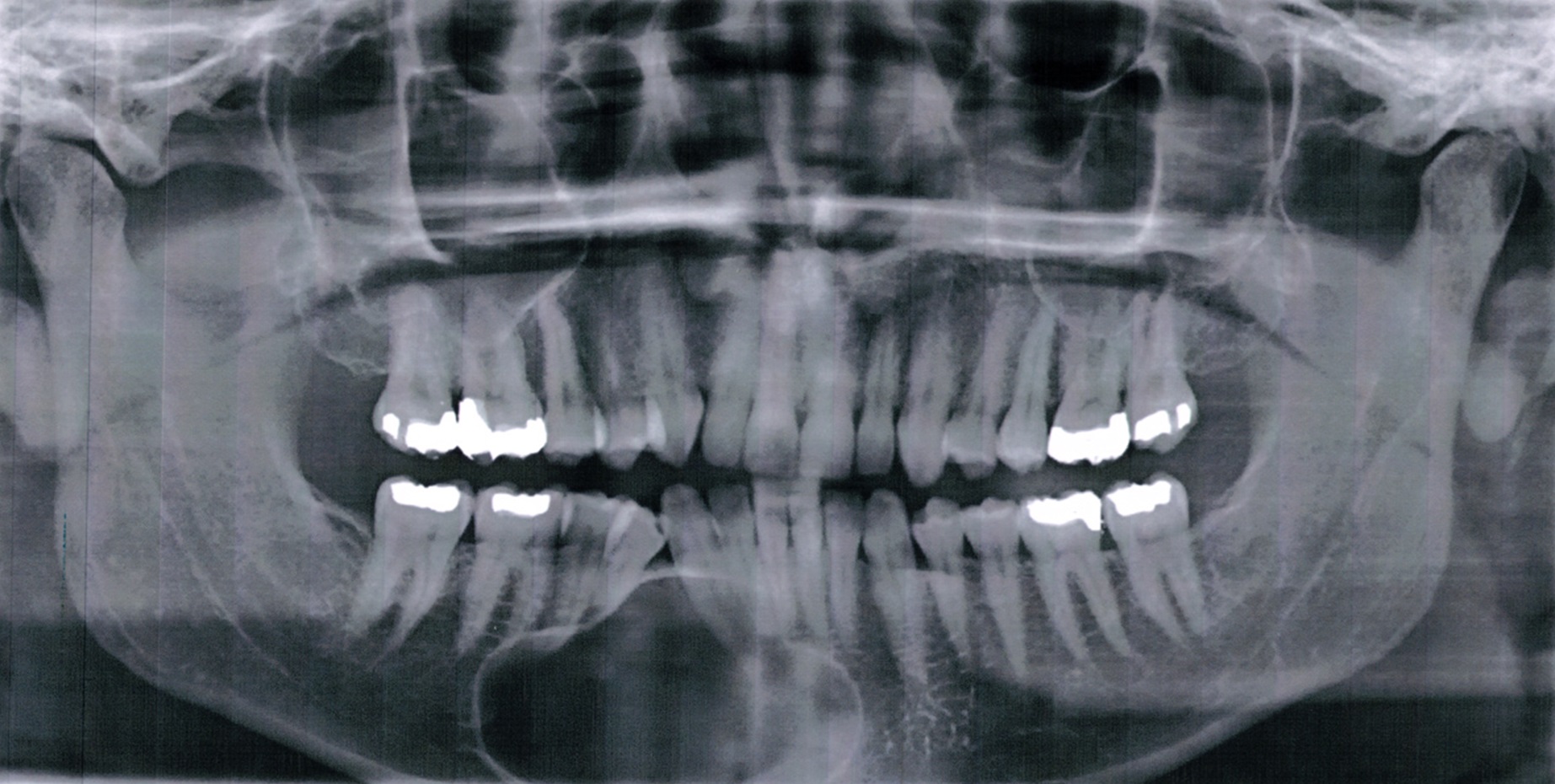 Xray image of a jaw